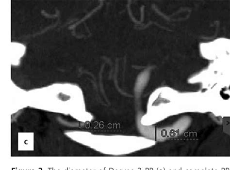 Figure 2 From Evaluation Of The Groove For Vertebral Artery Using Ct Angiography Semantic Scholar