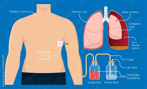 Symptom Spontaneous Iatrogenic Traumatic Pneumothorax Patient With