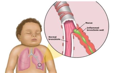 Pediatric Lower Airway Disorders Bronchiolitis RSV Respiratory