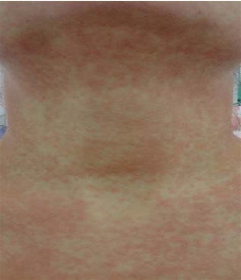 Figure From Drug Rash With Eosinophilia And Systemic Symptoms Dress