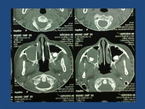 Case presentation of Gorlin Goltz syndrome