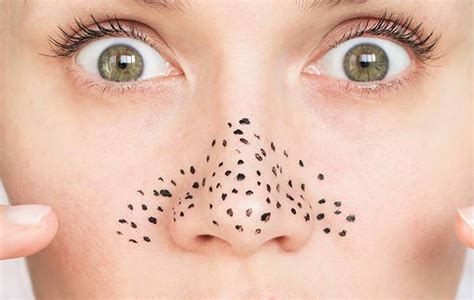 Cara Menghilangkan Komedo Di Hidung Beauty Plus Clinic