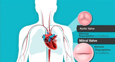 Mitral Valve Regurgitation Diagnosis And Treatment