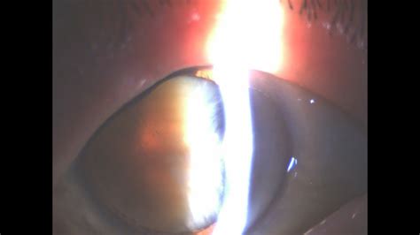 Nucleus Manipulation In Brunescent Cataract Surgery Phaco Chop Youtube