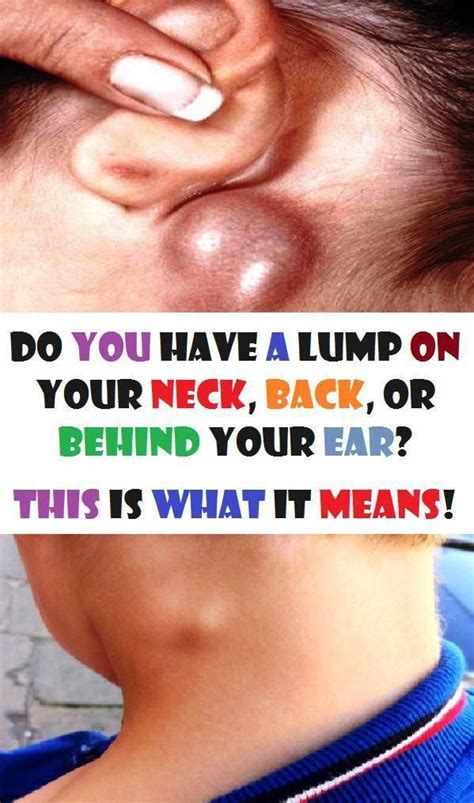 Do You have A Lump In your Neck, Back, Or Behind Your Ear? This really ...