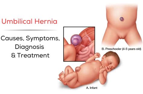 Umbilical Hernia Causes Symptoms Diagnosis Treatment Dr Apoorva