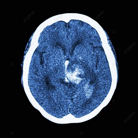 Stroke Hemoragik Diungkapkan Oleh Ct Scan Otak Foto Latar Belakang Dan