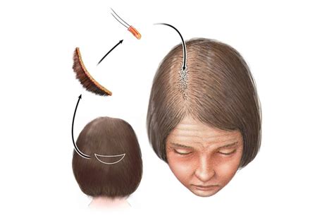 Hair Loss Treatment 🧬 Andro Genetic