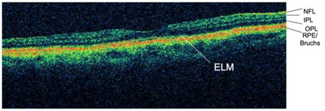 Optical Coherence Tomography Flashcards | Quizlet