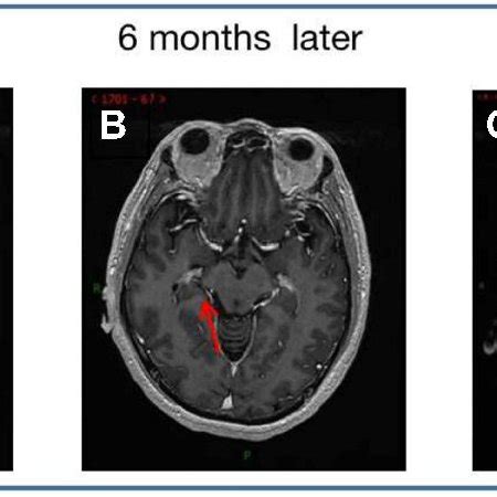 Brain Mri With Contrast Demonstrating One Brain Metastatic Lesion Red