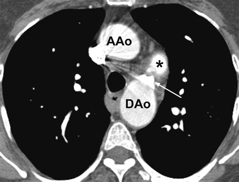 Incidental Finding On Mdct Of Patent Ductus Arteriosus Use Of Ct And