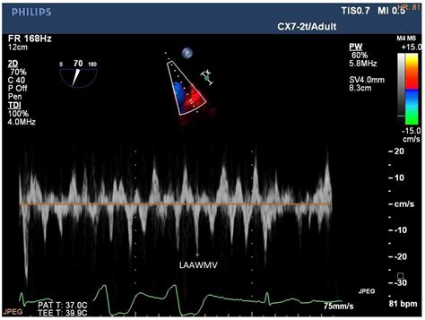 Jcm Free Full Text Echocardiographic Evaluation Of Atrial