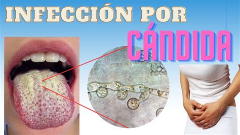 Infección por cándida y candidiasis Qué es YouTube