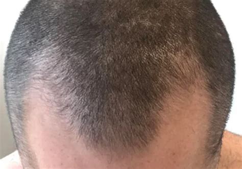 Microneedling Every 6 Weeks Plus Finasteride And Minoxidil Wrassman M