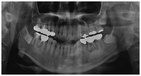 A Large Sialolith On The Parenchyma Of The Submandibular Gland A Case