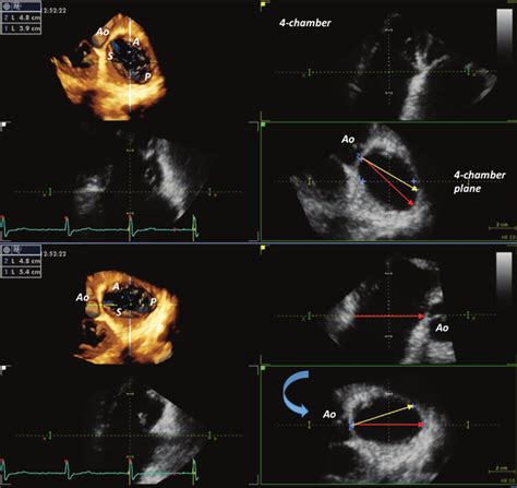 Impact of various methods of tricuspid annulus diameter sizing ...