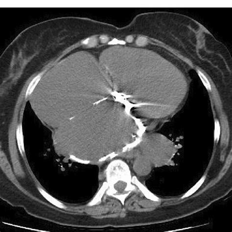 Axial Chest CT Scan Mediastinal Window Shows Extensive Left Atrial