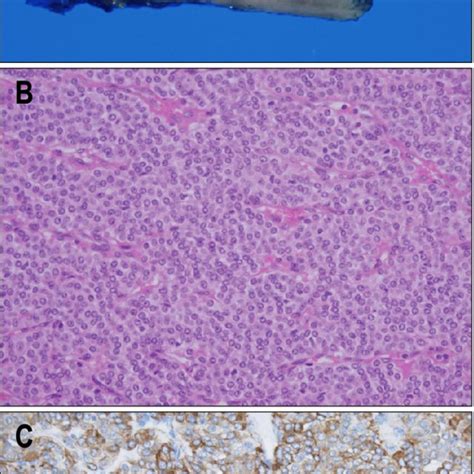 Pathologic Findings Of Resected Specimen A A Photograph Of Gross