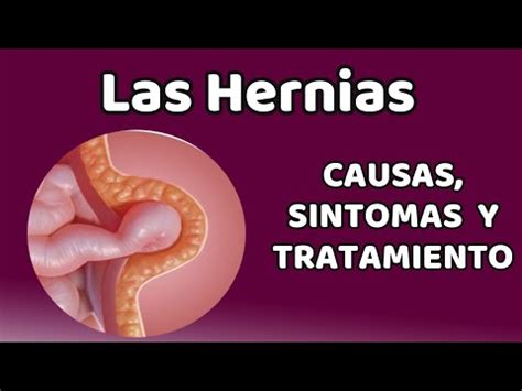 LAS HERNIAS Causas signos y síntomas diagnóstico y tratamiento YouTube