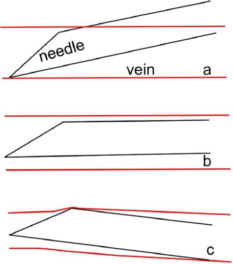 improving  success rate  intravenous cannulation pmc
