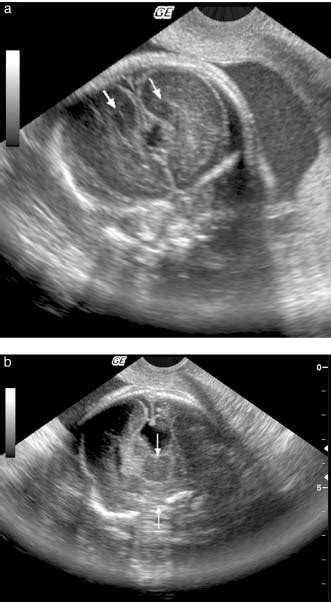 Transvaginal Ultrasound Image Of A Week Fetal Brain With Middle