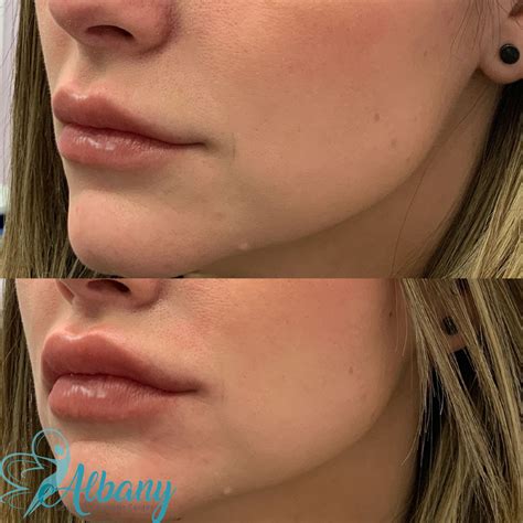 Lip Filler Enhancement Case No 1389 Albany Cosmetic And Laser Centre