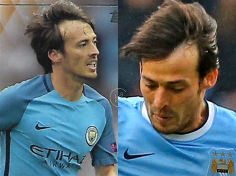 David Silva Hair Transplant - Hair Loss & Technical Analysis