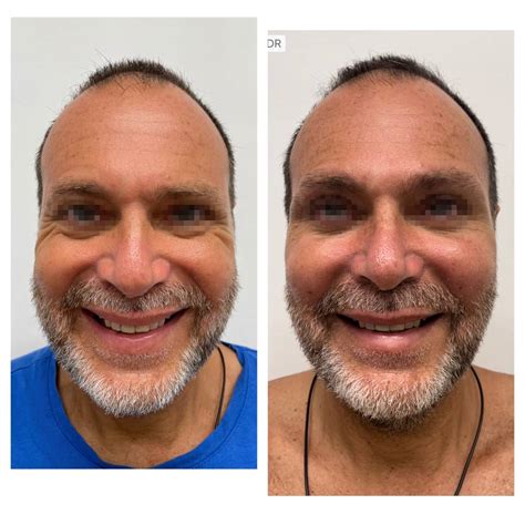 Antes y después de Lipofilling facial en hombres Terapia regenerativa