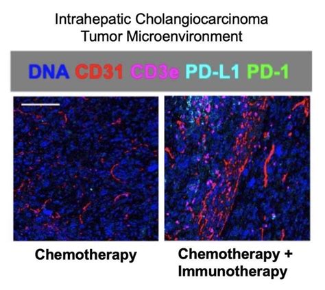 Publication Alert - Reprogramming the Intrahepatic Cholangiocarcinoma Immune Microenvironment ...