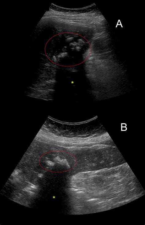 -Sagittal (A) and left-lateral decubitus (B) ultrasound images of the ...