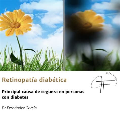 Retinopatía diabética Principal causa de ceguera Oftalmología Ibiza y