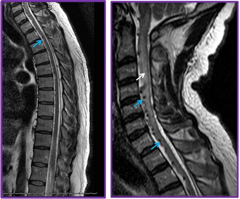 Spinal Dural Fistula | neuroangio.org