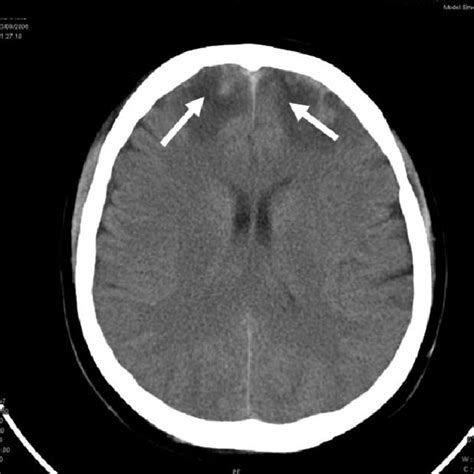 T2-weighted MRI of central nervous system showing bilateral contusion... | Download Scientific ...