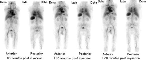 Estudio Isot Pico De Hemorragia Gastrointestinal Cl Nica Gammaimagen