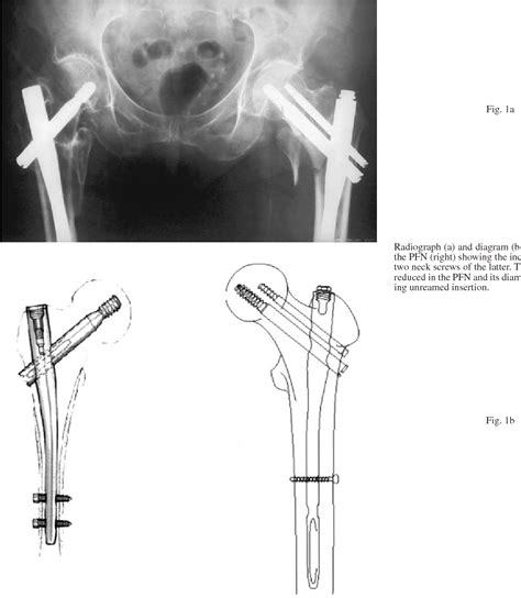 Figure From Treatment Of Unstable Trochanteric Fractures Randomised