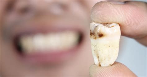 Tooth Decay And Tooth Cavities Symptoms Causes And Treatments