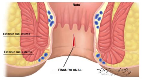 O que é Fissura Anal Sintomas e tratamentos Dr Fernando Bray