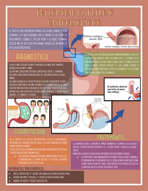 Enfermedad Por Reflujo Gastroesofagico 3d Infografia De Reflujo Acido