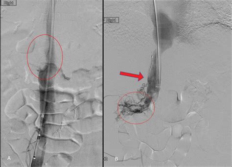 Case 1— Venacavogram With Filling Defect Representing Thrombus In