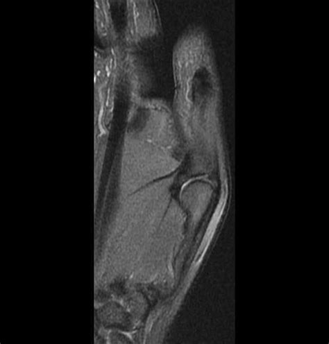 Ulnar Collateral Ligament Of Carpometacarpal Joint Of Thumb E Anatomy