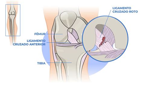 Tiempo de recuperación de esguince de ligamento de rodilla DonComo