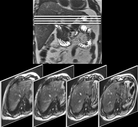 Liver Mr Elastography Technique And Image Interpretation Pearls And