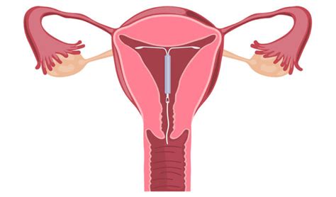 Dispositivo Intra Uterino Diu O Que é Vantagens E Desvantagens