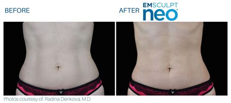 Emsculpt Vs Coolsculpting Which Treatment Is Best For You