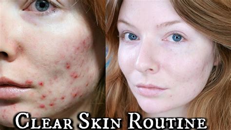 Clear Skincare Routine For Acne How I Cleared My Skin Talk Through