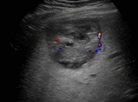 Abdomen and retroperitoneum | 1.1 Liver : Case 1.1.1 Focal nodular ...