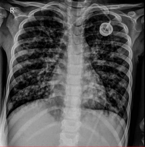 Cystic Fibrosis Basic Diagnostic Features Of Pulmonological Diseases