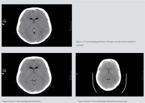 Figure From Symptomatic Pneumocephalus As A Complication Of Lumbar