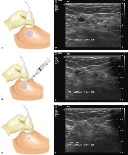 Cyst Drainage Procedure Best Drain Photos Primagem Org