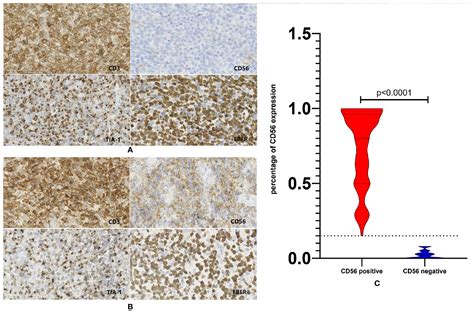 Frontiers Cd Negative Extranodal Natural Killer T Cell Lymphoma A